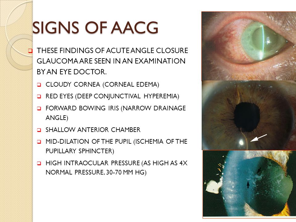 ACUT ANGLE CLOSURE GLAUCOMA ppt video online download